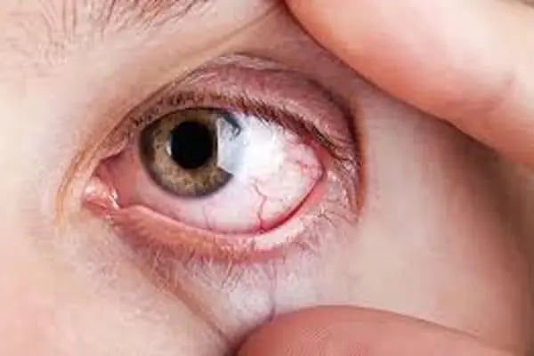 Prof. Dr. Yüksel Totan - Göz Doktoru - Retina Hastalıkları - Resim 10