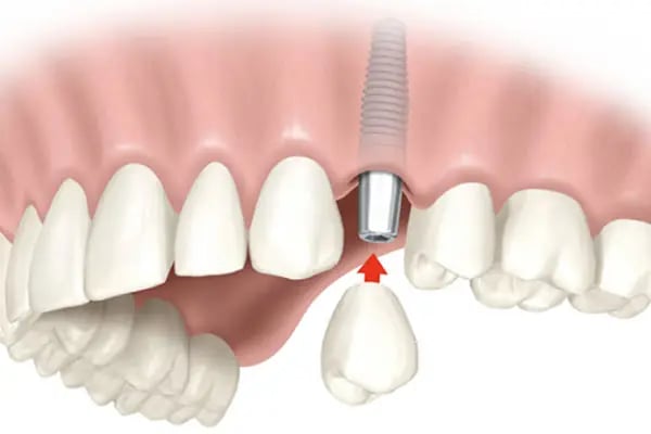 Dentalazer Ağız ve Diş Sağlığı Polikliniği - Resim 12