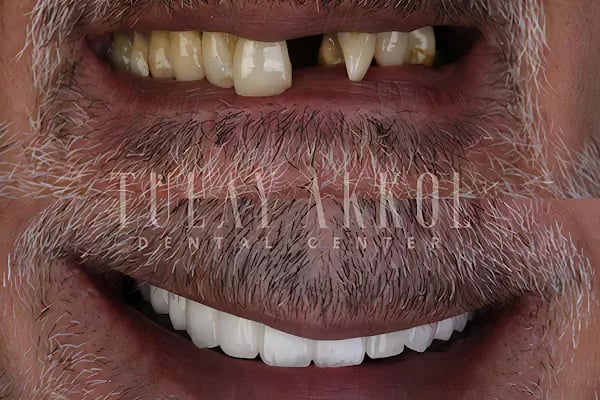 Tülay Akkol Dental - Antalya Dental Clinic - Antalya Diş Hekimi - Doktoru - Resim 2