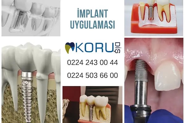 Diş Hekimi Osman Babaemin Estetik Diş Hekimligi &amp; Gülüş Tasarımı &amp; İmplant - Resim 8