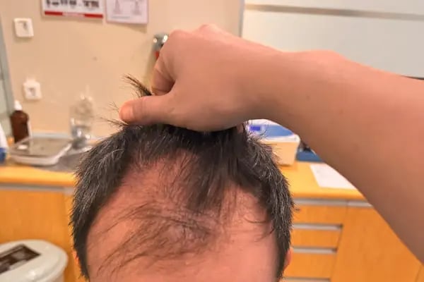 Bilyana Hair Clinic Saç Ekim Merkezi - Resim 11