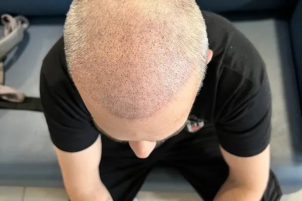 Bilyana Hair Clinic Saç Ekim Merkezi - Resim 14