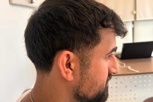 Bilyana Hair Clinic Saç Ekim Merkezi - Resim 9