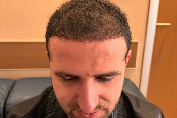 Bilyana Hair Clinic Saç Ekim Merkezi - Resim 5