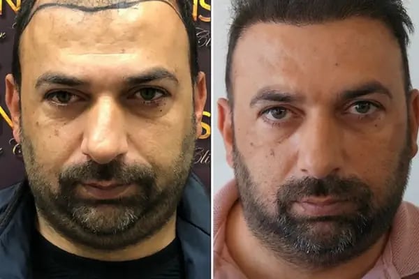 Hair Transplant Of Antalya / Antalya Saç Ekimi / Altınsoy Hair Clinic - Resim 2