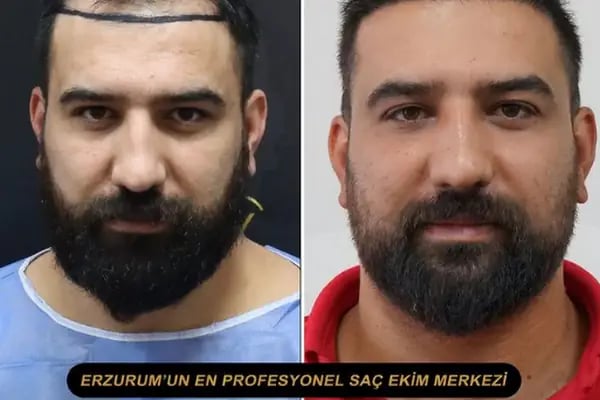 Hair Transplant Of Antalya / Antalya Saç Ekimi / Altınsoy Hair Clinic - Resim 13