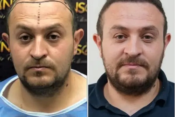 Hair Transplant Of Antalya / Antalya Saç Ekimi / Altınsoy Hair Clinic - Resim 8