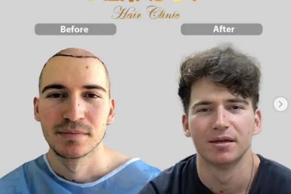 Hair Transplant Of Antalya / Antalya Saç Ekimi / Altınsoy Hair Clinic - Resim 12