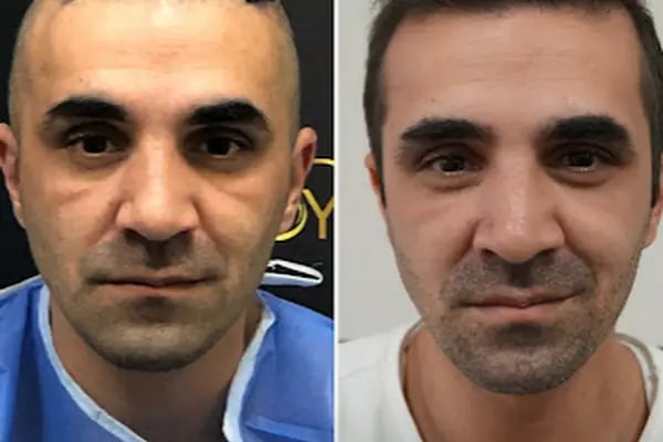 Hair Transplant Of Antalya / Antalya Saç Ekimi / Altınsoy Hair Clinic - Resim 10