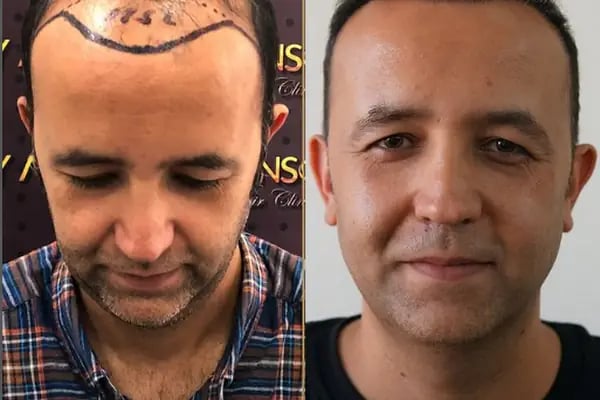 Hair Transplant Of Antalya / Antalya Saç Ekimi / Altınsoy Hair Clinic - Resim 4