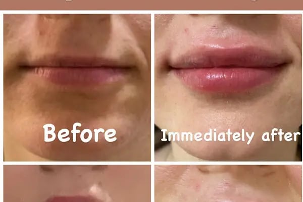 Dermatolog Prof Dr Şule Güngör, fraksiyonel lazer, akne izi tedavisi , İstanbul Kök hücre, Botoks (Botox) , Dolgu Saç Ekimi - Resim 7