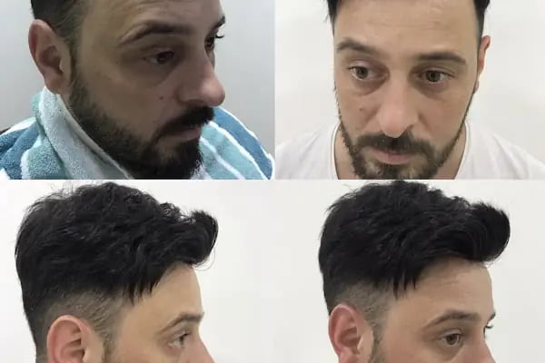 Hair Lost Protez Saç Merkezi - Resim 6