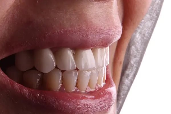 Dentium Meram - Konya, Diş Hekimi, Özel, İmplant, Zirkonyum, Gülüş Tasarımı - Resim 6