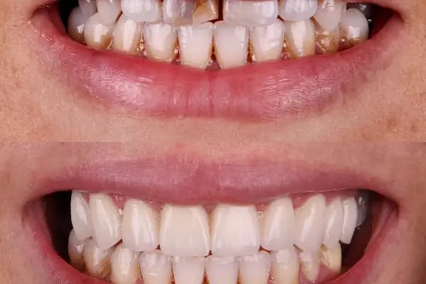 Dentium Meram - Konya, Diş Hekimi, Özel, İmplant, Zirkonyum, Gülüş Tasarımı - Resim 8