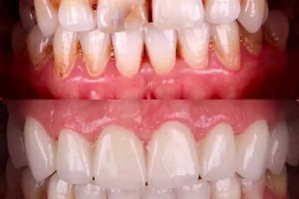 Dentium Meram - Konya, Diş Hekimi, Özel, İmplant, Zirkonyum, Gülüş Tasarımı - Resim 10