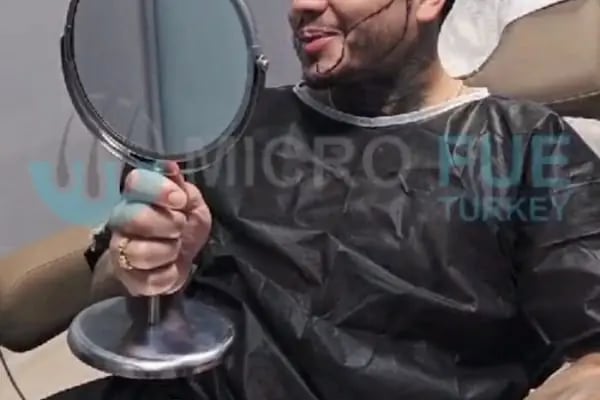 Beard Transplant Turkey - Resim 16