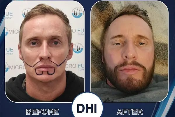 Beard Transplant Turkey - Resim 8