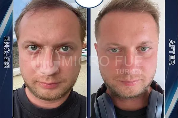 Beard Transplant Turkey - Resim 10