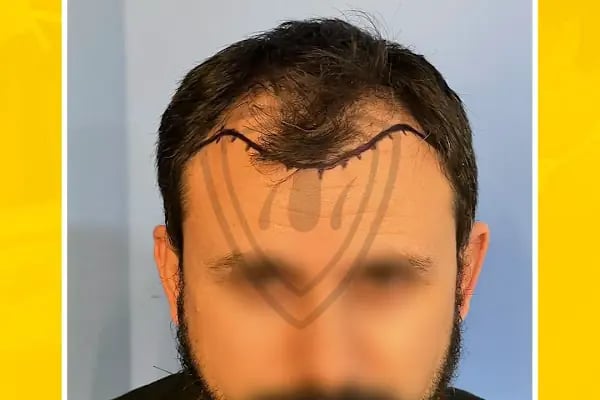 Live Hair Clinic - Resim 3