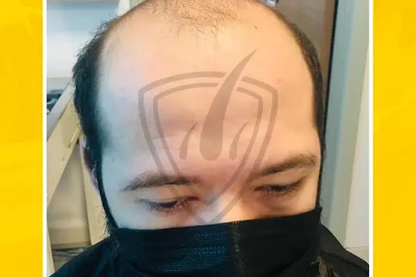 Live Hair Clinic - Resim 10