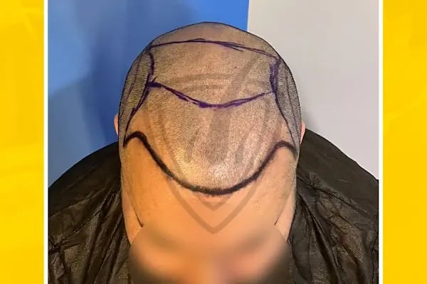 Live Hair Clinic - Resim 20