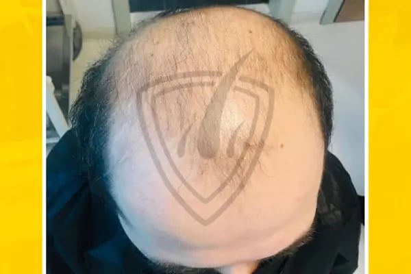 Live Hair Clinic - Resim 7