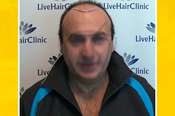 Live Hair Clinic - Resim 8