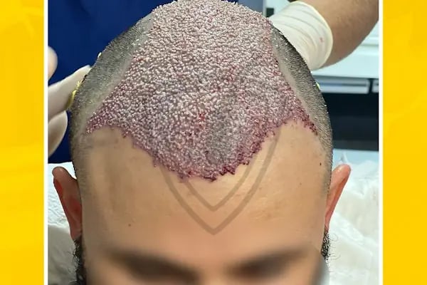 Live Hair Clinic - Resim 11