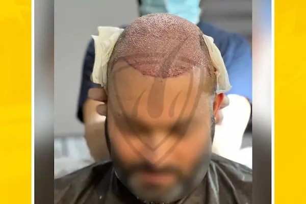 Live Hair Clinic - Resim 13
