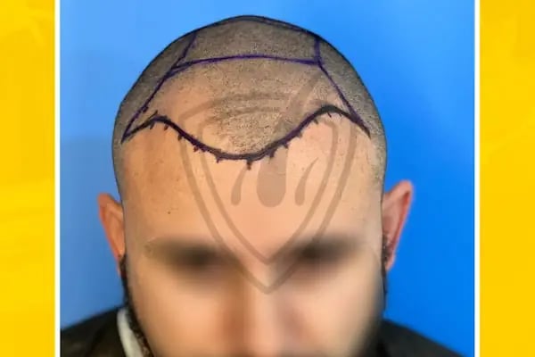 Live Hair Clinic - Resim 12