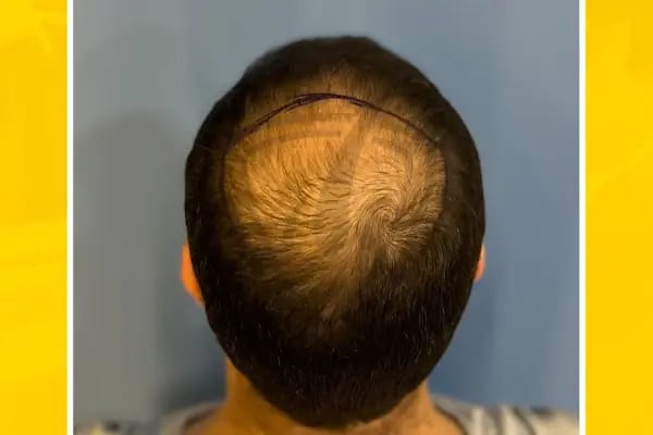 Live Hair Clinic - Resim 18