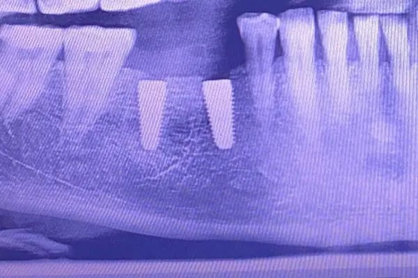 Suruç Özel Diş Kliniği - Dt. Arslan DEMİRBOĞA - Resim 6