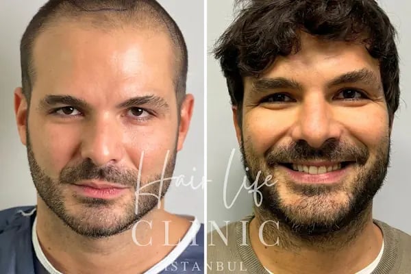 Hair Life Saç Ekim Merkezi - Resim 10