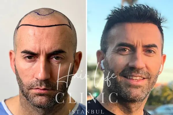 Hair Life Saç Ekim Merkezi - Resim 18