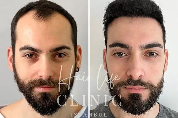 Hair Life Saç Ekim Merkezi - Resim 17