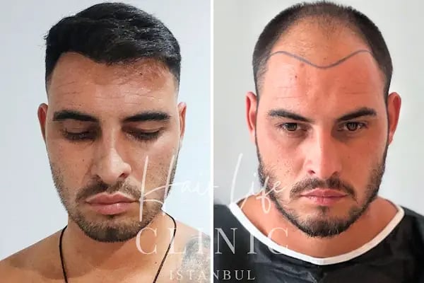 Hair Life Saç Ekim Merkezi - Resim 11