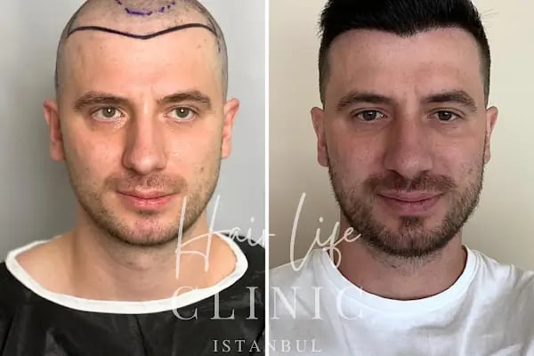 Hair Life Saç Ekim Merkezi - Resim 19