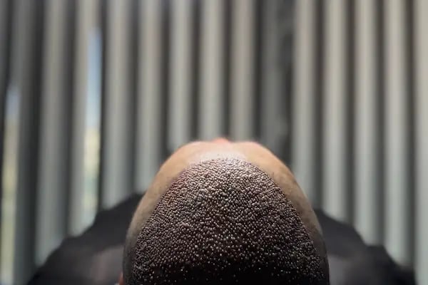 Hair Life Saç Ekim Merkezi - Resim 8