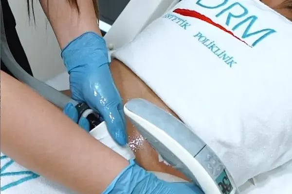 Özel DRM Polikliniği | Medikal Estetik | Lazer Epilasyon - Resim 6