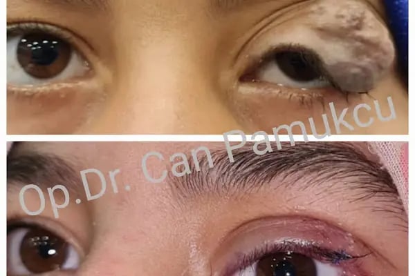 Op. Dr. Can Pamukcu Göz Kliniği, Göz Kapağı Hastalıkları ve estetiği, Protez Göz, Göz Tembelliği, Şaşılık, fraksiyonel lazer - Resim 20