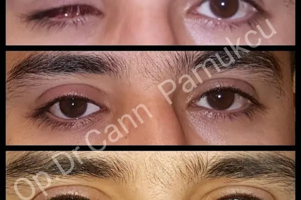 Op. Dr. Can Pamukcu Göz Kliniği, Göz Kapağı Hastalıkları ve estetiği, Protez Göz, Göz Tembelliği, Şaşılık, fraksiyonel lazer - Resim 19