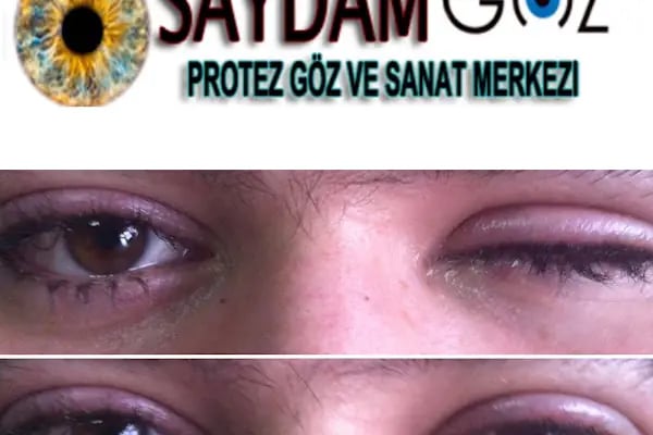 Saydam Protez Göz Sanat Merkezi %98 Uyum - Resim 2