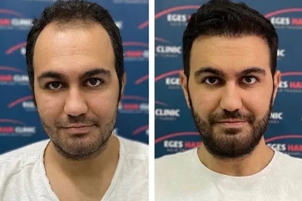 DR. BABACAN Medikal Estetik Saç Ekim&amp;Lazer Epilasyon&amp;Zayıflama - Resim 18