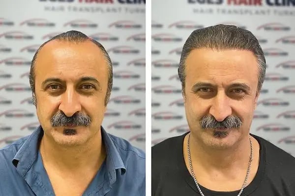 DR. BABACAN Medikal Estetik Saç Ekim&amp;Lazer Epilasyon&amp;Zayıflama - Resim 16