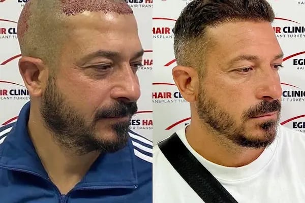 DR. BABACAN Medikal Estetik Saç Ekim&amp;Lazer Epilasyon&amp;Zayıflama - Resim 5