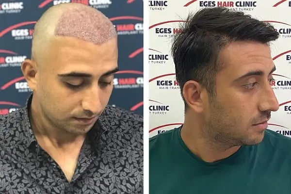 DR. BABACAN Medikal Estetik Saç Ekim&amp;Lazer Epilasyon&amp;Zayıflama - Resim 19