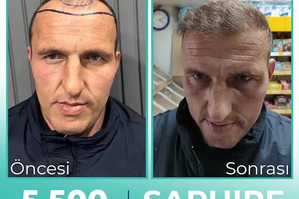 Carla Clinic Saç Ekim Merkezi Avcılar - Resim 14