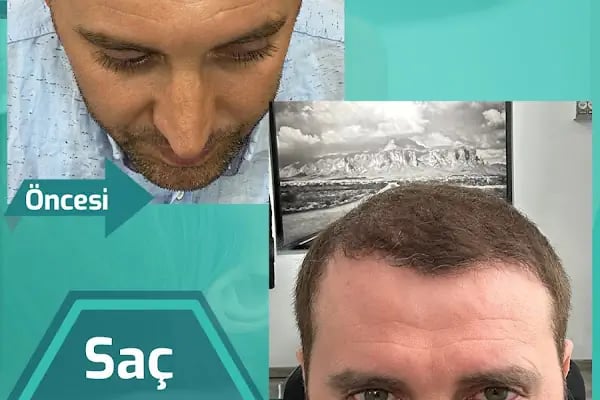 Carla Clinic Saç Ekim Merkezi Avcılar - Resim 17