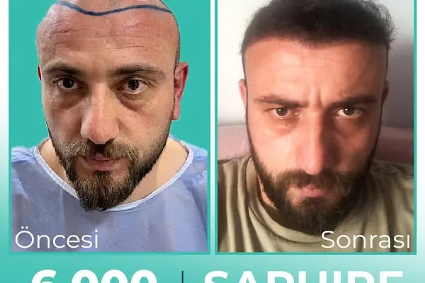 Carla Clinic Saç Ekim Merkezi Avcılar - Resim 12