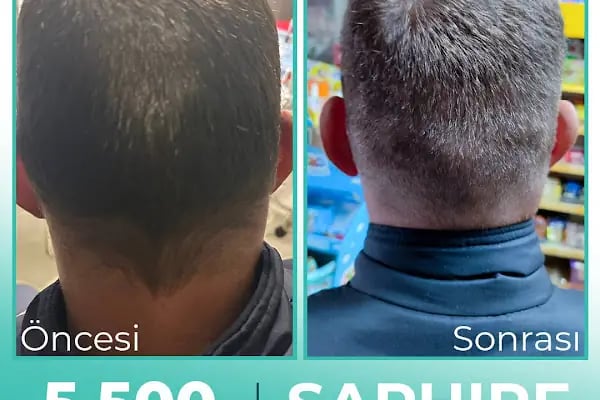 Carla Clinic Saç Ekim Merkezi Avcılar - Resim 6